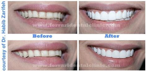 Composite Veneers Before And After