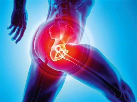 What is The Main Cause of Needing a Hip Replacement?