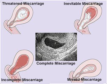 What to Do After a Miscarriage - Eastside Gynecology