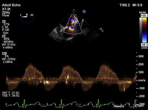 Continuous-wave Doppler echocardiography of the pulmonic valve shows a... | Download Scientific ...