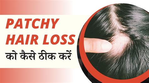 Patchy Hair Loss को कैसे ठीक करें | Patchy Hair Loss Treatment | Alopecia Areata Treatment ...