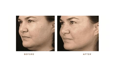 Thermage Face Gallery | Infinity Skin Clinic Sydney