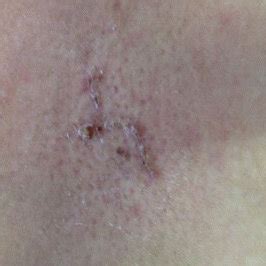 Skin rash 1 week after surgery. Improvement of the lesion after the ...