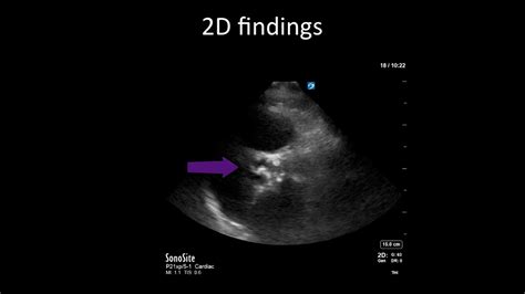 Aortic Valve Echo