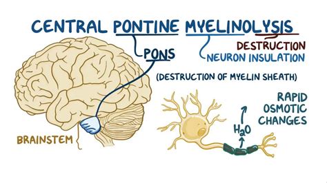 Central pontine myelinolysis: Video & Anatomy | Osmosis