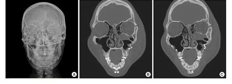 Figure 1 from Zygomaticomaxillary complex fracture after two-jaw ...