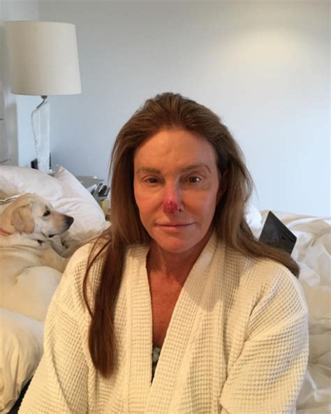 Caitlyn Jenner shares graphic photo after having skin cancer cut from her nose