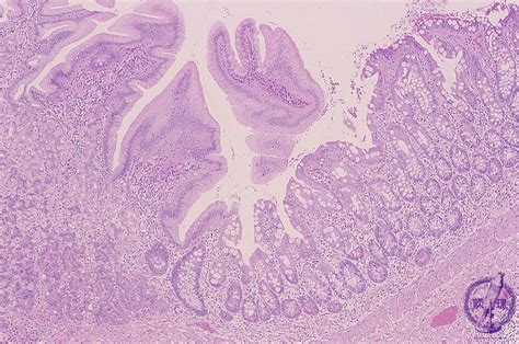 22.Pediatric pathology (5) Meckel diverticulum|Pathology Core Pictures