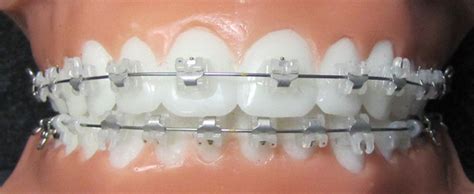 Self-Ligating Braces - Macomb Township MI | Macomb Orthodontics