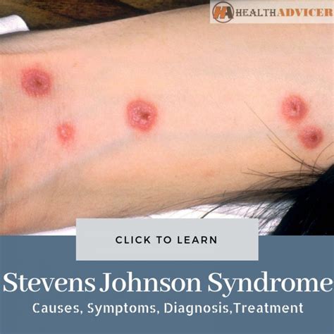 Stevens Johnson Syndrome: Causes, Symptoms, Diagnosis And Treatment