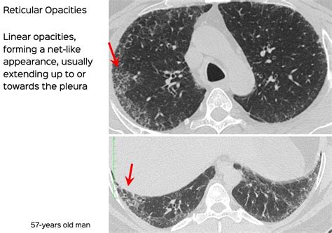 Lecture: Fibrosing ILDs - Understanding Reticular Opacities, Traction Bronchiectasis and ...