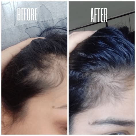 Minoxidil 3 month progress : FemaleHairLoss