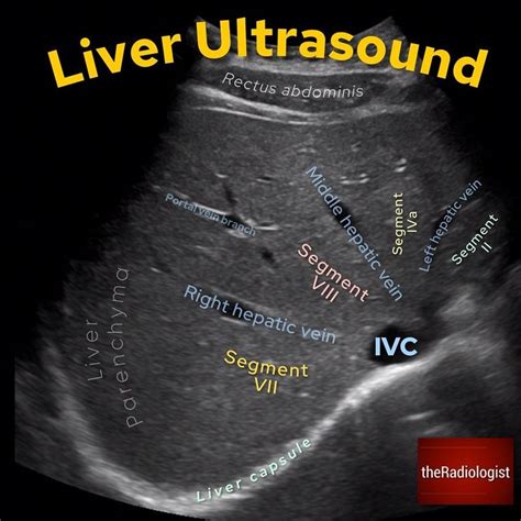 The Radiologist on Instagram: “LIVER ULTRASOUND⁣ ⁣ 👨🏽‍💻Ultrasound of the liver is a key tool ...