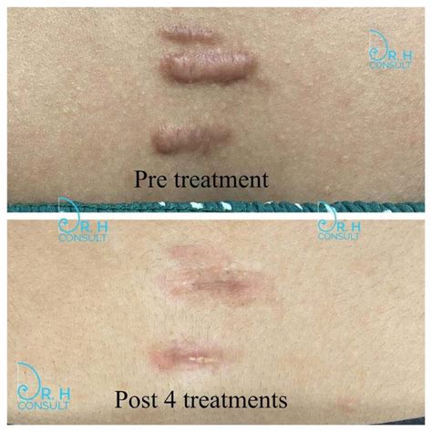 Keloid Scar Treatment / Removal London & Surrey | Dr H Consult