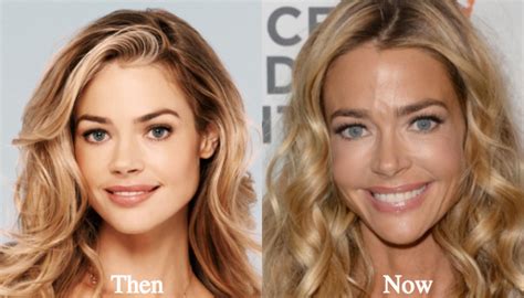 Denise Richards Plastic Surgery Before and After Photos - Latest ...