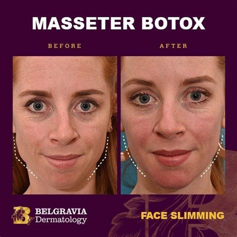 Masseter Botox Injection Technique