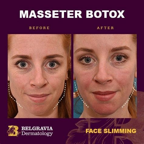 Masseter Muscle Botox Before And After