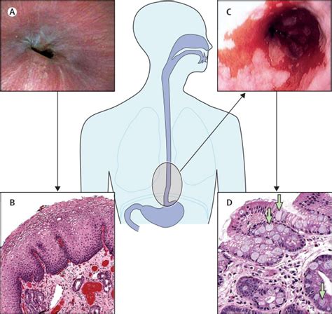 Barrett's oesophagus - The Lancet