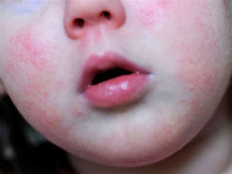 Scarlet Fever Rash Face