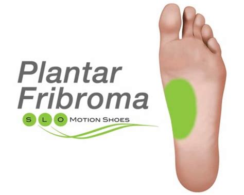 Plantar Fibroma - SLO Motion ShoesSLO Motion Shoes