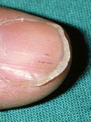 What Are The White Spots On Your Nails Trying to Tell You?