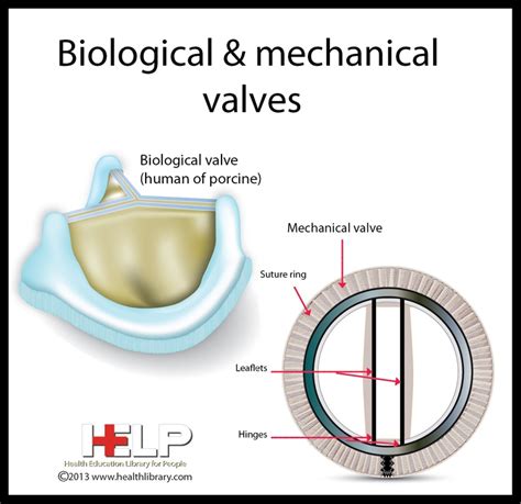 Biological & Mechanical Valves | Aortic valve replacement, Heart ...