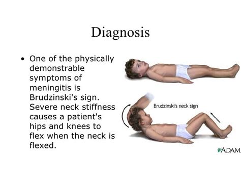 Meningitis