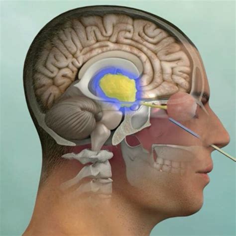 Craniopharyngioma: Symptoms, Diagnosis and Treatment | Pacific Pituitary Disorders Center