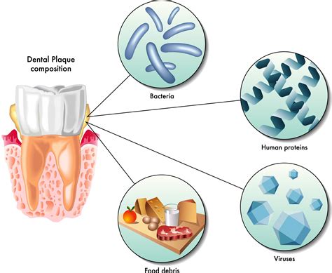 What Is Gum Disease? The California Society of Periodontists