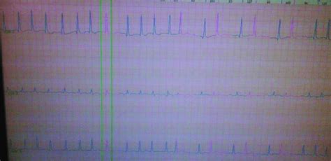 Holter monitor showing atrial fibrillation. | Download Scientific Diagram