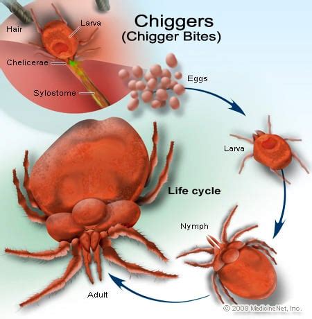 Chiggers Causes, Symptoms, Treatment - Chiggers Symptoms - eMedicineHealth