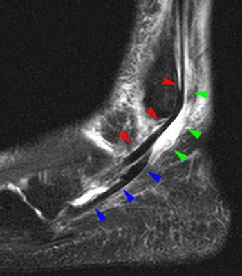 Peroneal Tendon Dislocation and Superior Peroneal Retinaculum Injury ...