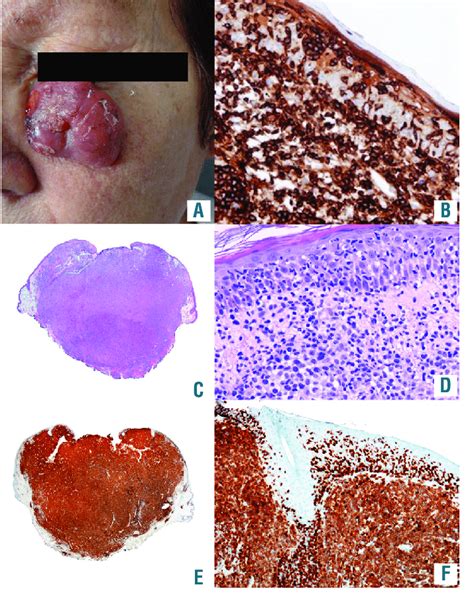 ALK-negative primary cutaneous anaplastic large cell lymphoma with... | Download Scientific Diagram