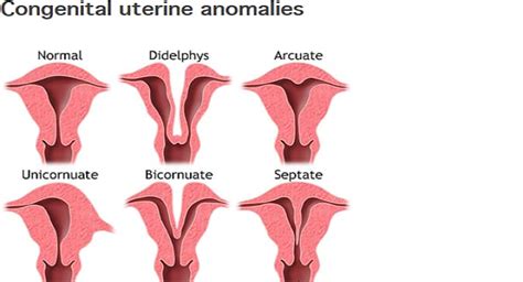 Understanding Congenital Uterine Abnormalities: How Does It Impact ...