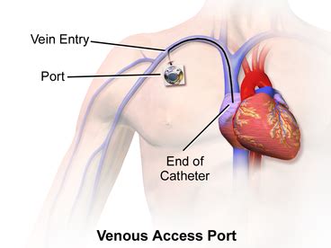 Intravenous Lines - Physiopedia