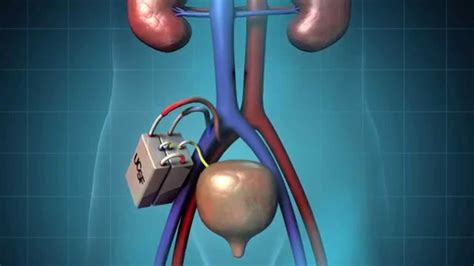 The Kidney Project: Implantable Kidney | The Proactive Path