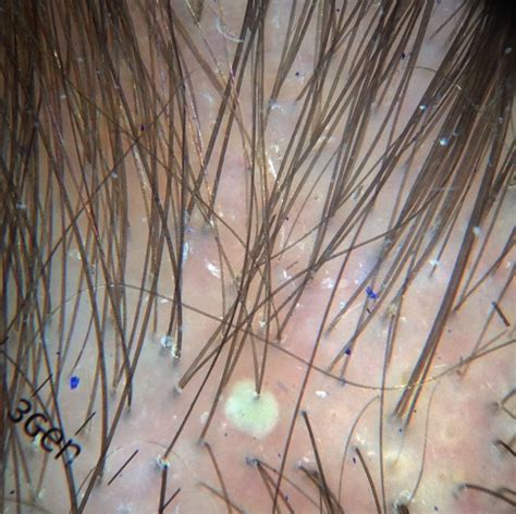 Scalp Folliculitis - not a single entity — Donovan Hair Clinic