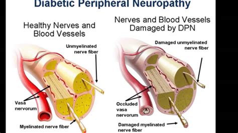 Diabetes Neuropathy:Causes,Symptoms,Treatment & Complication » How To Relief