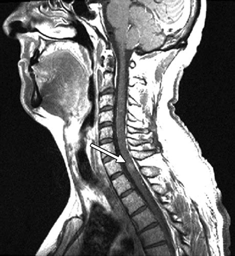 Cervical Spine Mri Multiple Sclerosis