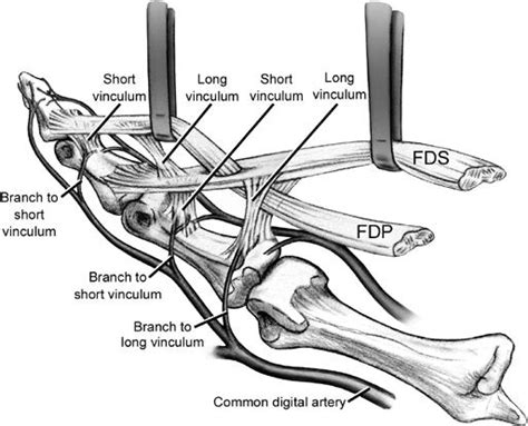 Flexor Tendon Injuries - Hand - Orthobullets