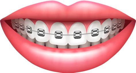 Best Orthodontics Illustrations, Royalty-Free Vector Graphics & Clip Art - iStock