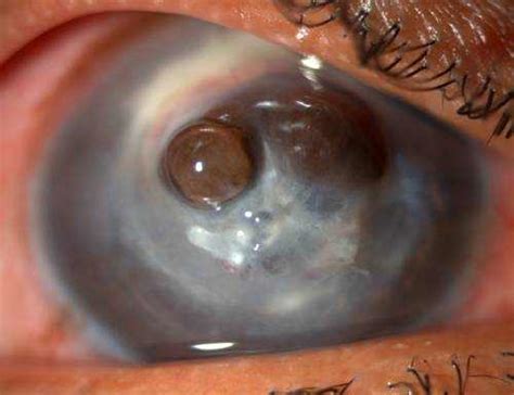 When Do Eye Drops Work for Fungal Infection? | EYExan.com