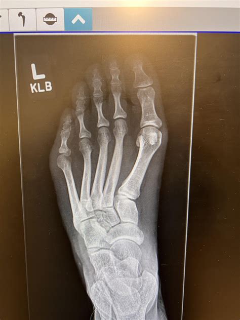 Before and after tailor bunion surgery (metatarsus adductus deformity edition) : r/bunions