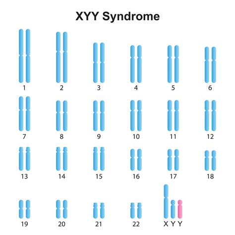 Définition | Syndrome 47,XYY - Syndrome de Jacob