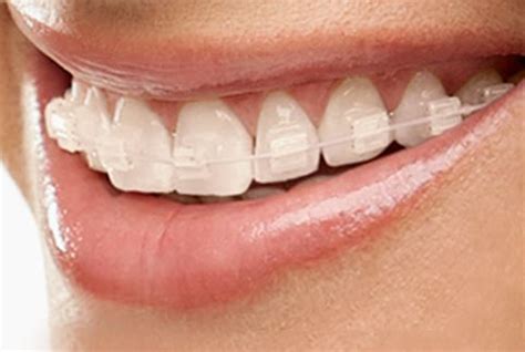 How to Stop or Prevent Ceramic Braces from Staining