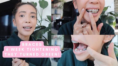 BRACES CHECK UP! THEY TURNED GREEN!! :( - YouTube