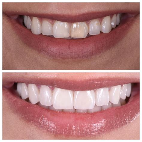 Wanna Try That Veneer Life? Read This Before Making an Appointment | Dental veneers, Cosmetic ...