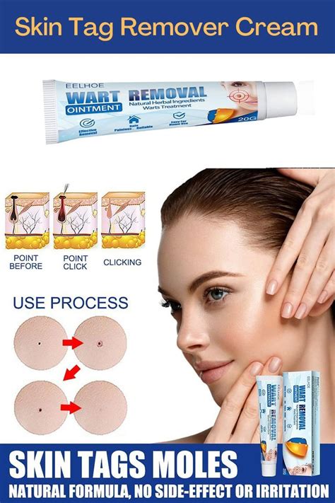 Safe & Quickly Remove Skin Tag, Wart and Callus | Skin tag, Skin tag removal, Tag remover