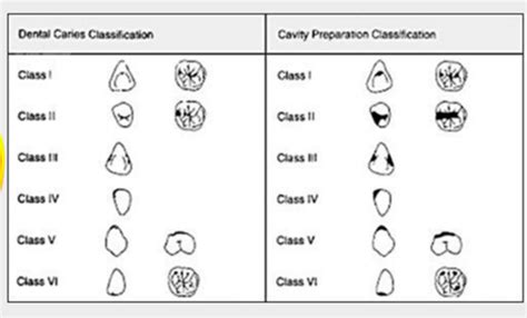 QA Topic 6 Classification of cavities by Black, the basis of classification. Preparation design ...