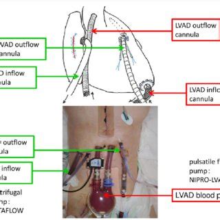 Clinical course before biventricular assist device implantation. BiVAD ...